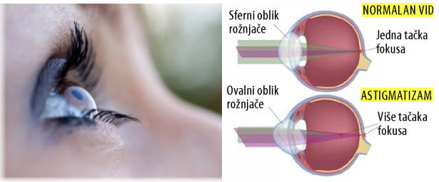 astigmatizam oka simptomi