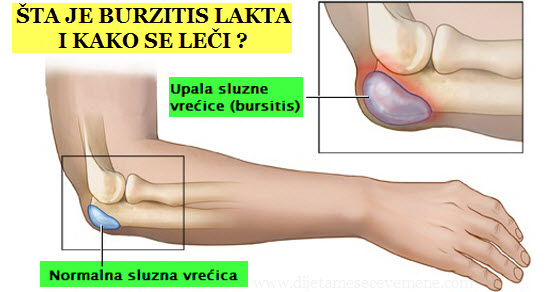 liječenje artroza lakta na laktu)