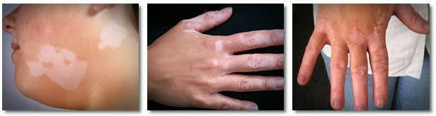 vitiligo bolest slike