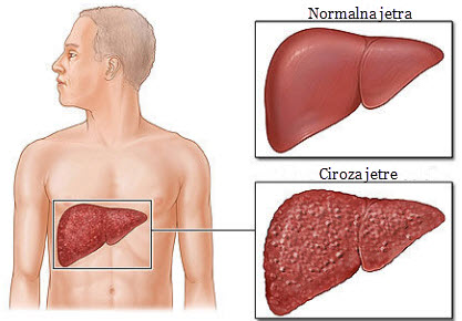 ciroza jetre simptomi koji ukazuju na problem