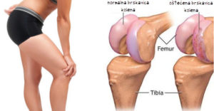 kako obnoviti hrskavicu kolena