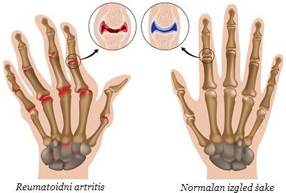 artritis reumatskih bolova)