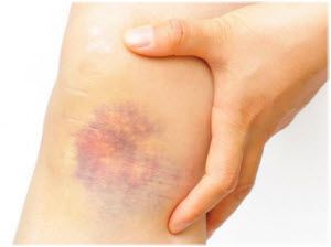modrice na nogama bolovi u zglobovima liječenje sol artroze