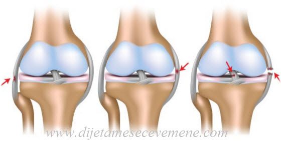 bol u desnoj nozi oticanje zgloba koljena