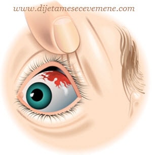krvarenje u oku hipertenzije