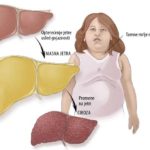 masna jetra simptomi | lecenje | dijeta | ishrana | steatoza jetre