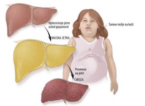 masna jetra simptomi koje ne smete zanemariti