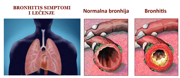 koji su bronhitis simptomi