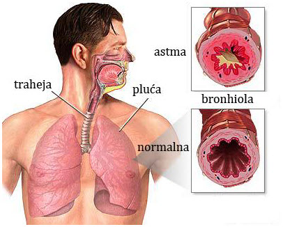 bronhijalna astma simptomi