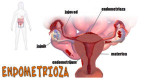 simptomi_endometrioze_jajnika