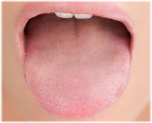 Eliminišite suva usta i jezik domaćim lekovima