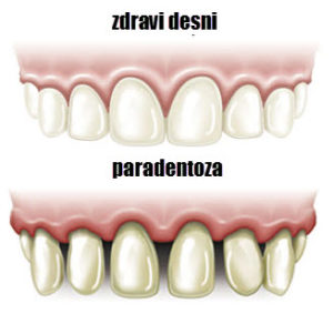paradentoza zuba simptomi u ranoj fazi
