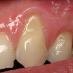 Paradentoza zuba simptomi i prirodno lečenje