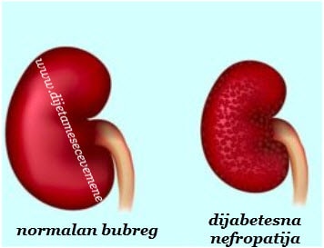 dijabetesna nefropatija simptomi bolesti 