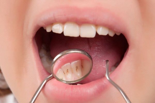 kako ukloniti kamenac na zubima
